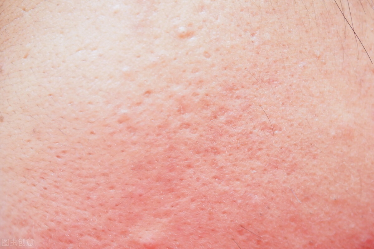 t区毛孔粗大还能收缩回去吗,炎症引起的毛孔粗大怎么缩回去