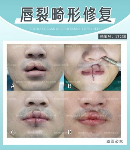 嘴巴缺了一小块肉多久能好,嘴巴好像缺了一块肉怎么回事