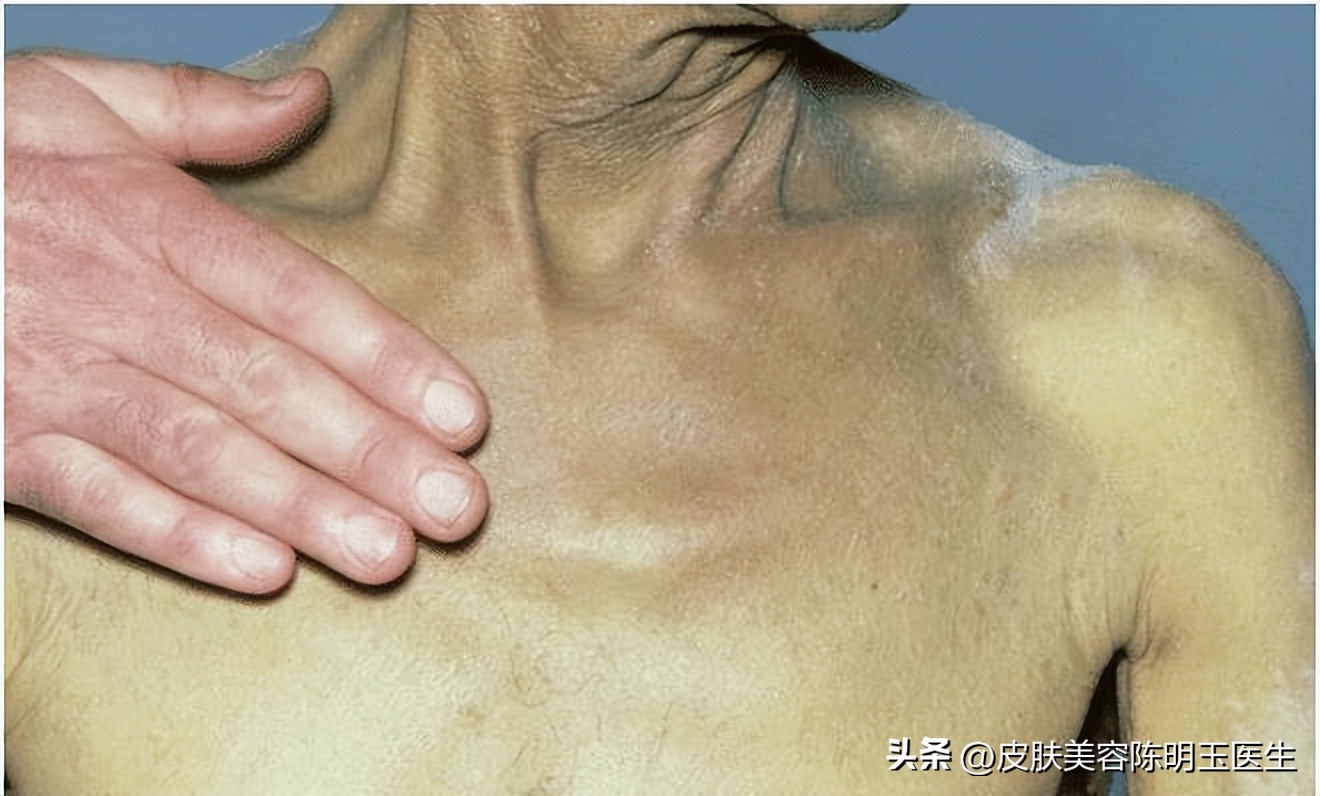 皮肤长红痣是肝有毛病,身上长出红痣是肝脏出了问题吗