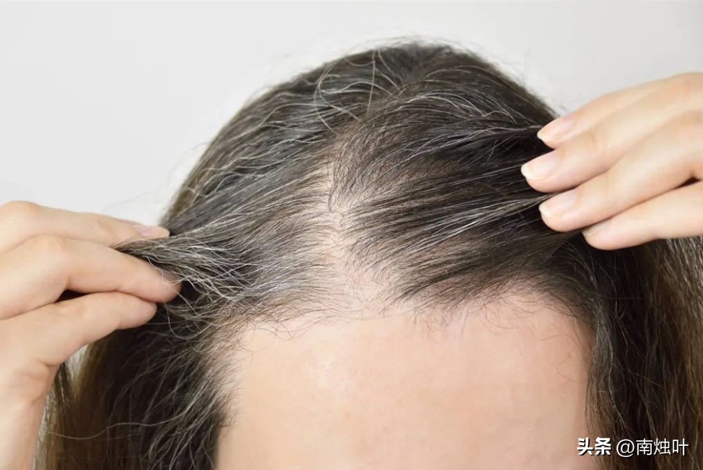 为什么压力大时会长白头发？这些习惯可以控制白发增多！