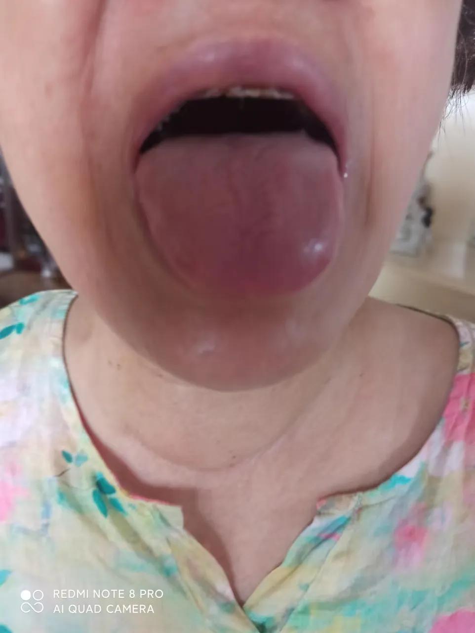 口服中药3个月，确诊5年的干燥综合征患者病情明显缓解