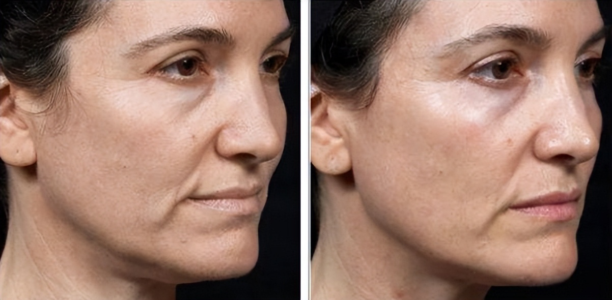 美容超声刀有危险吗,美容版超声刀的坏处