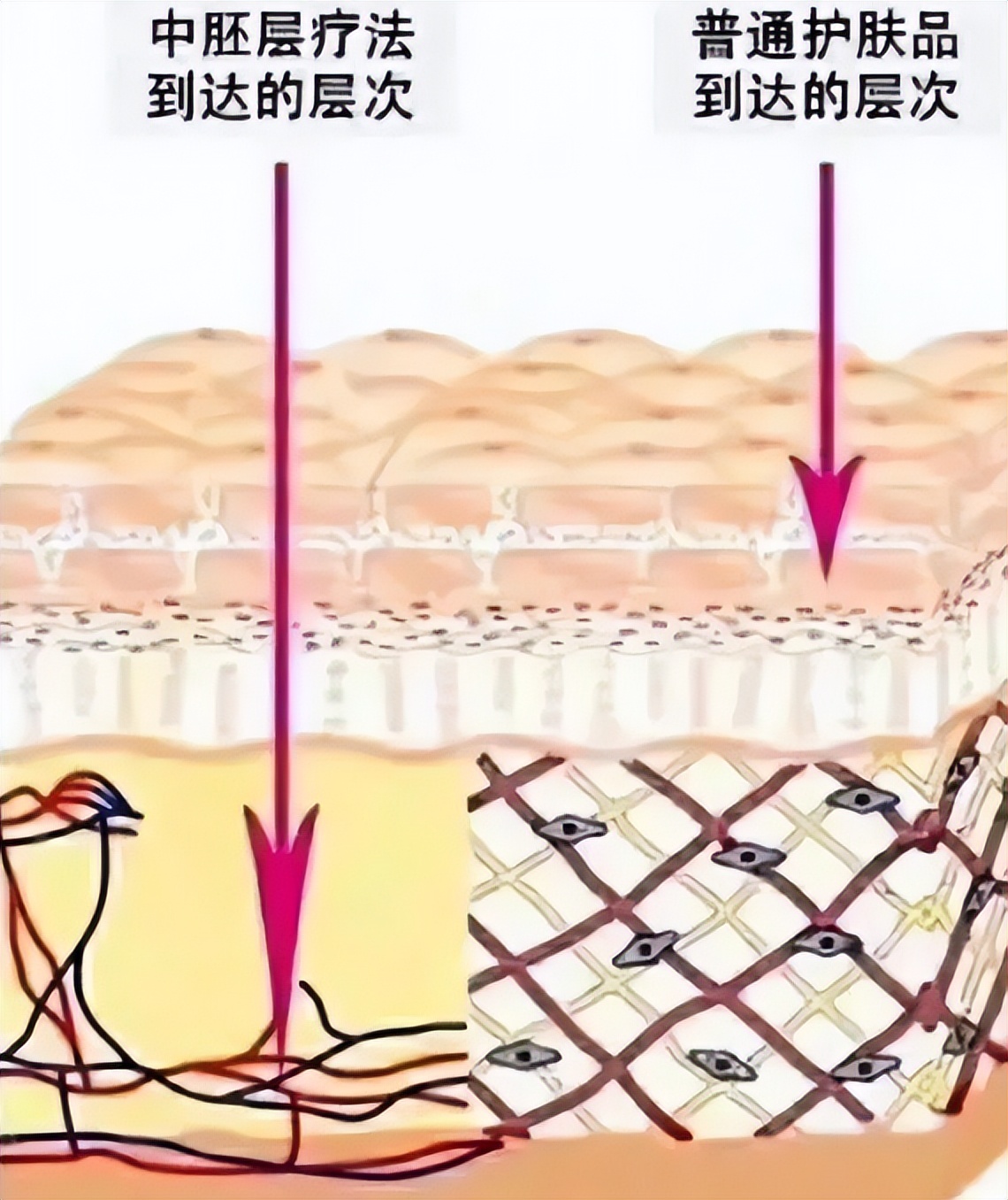 打水光针的痛苦,打水光针的惨痛经历