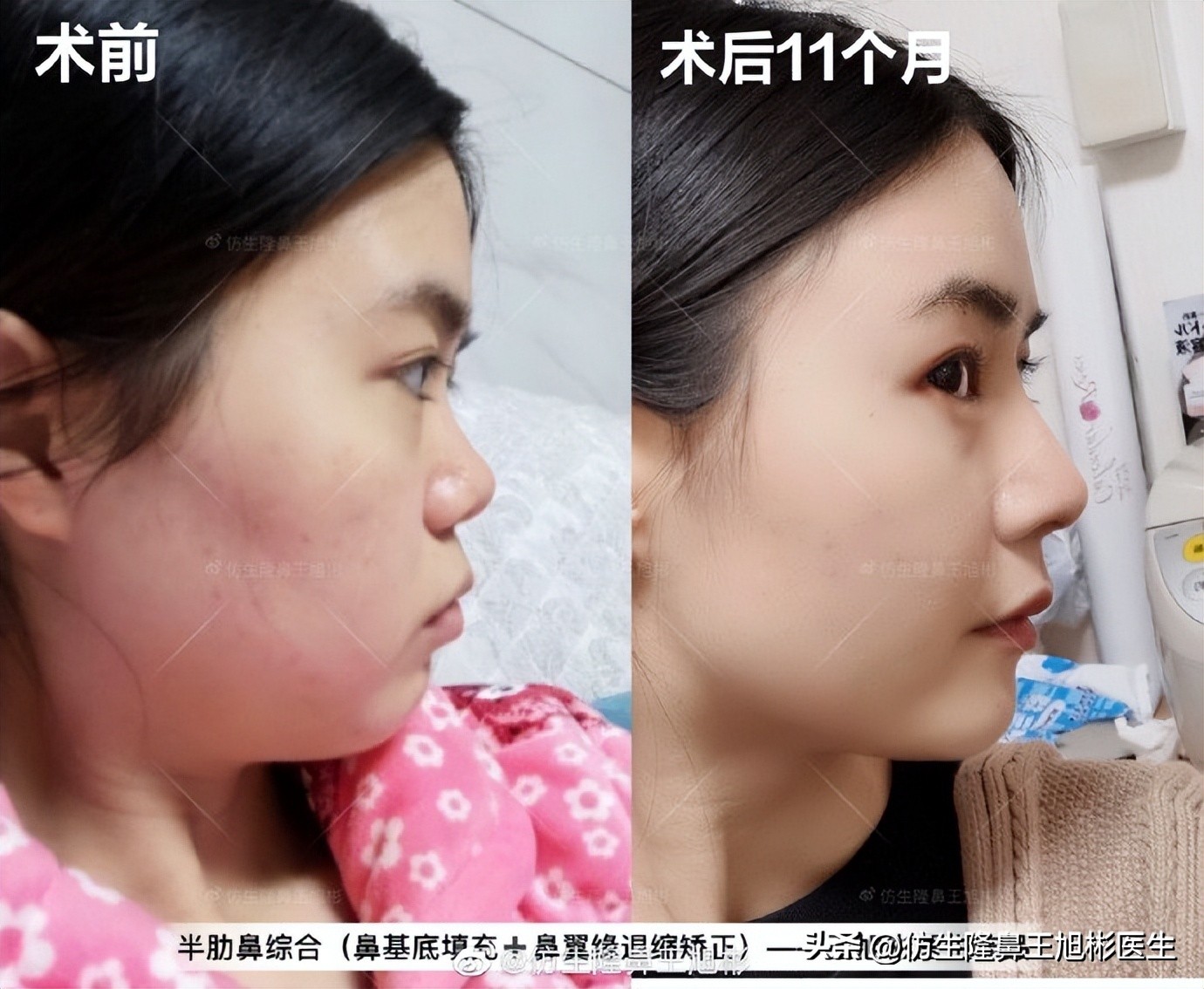 隆鼻鼻型科普,鼻基底凹陷隆鼻可以改善吗