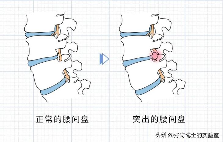 哪些姿势对腰部有损伤,哪种姿势对腰的伤害大
