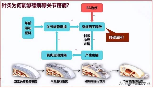针灸治疗关节炎效果怎么样,针灸能治腿关节炎吗
