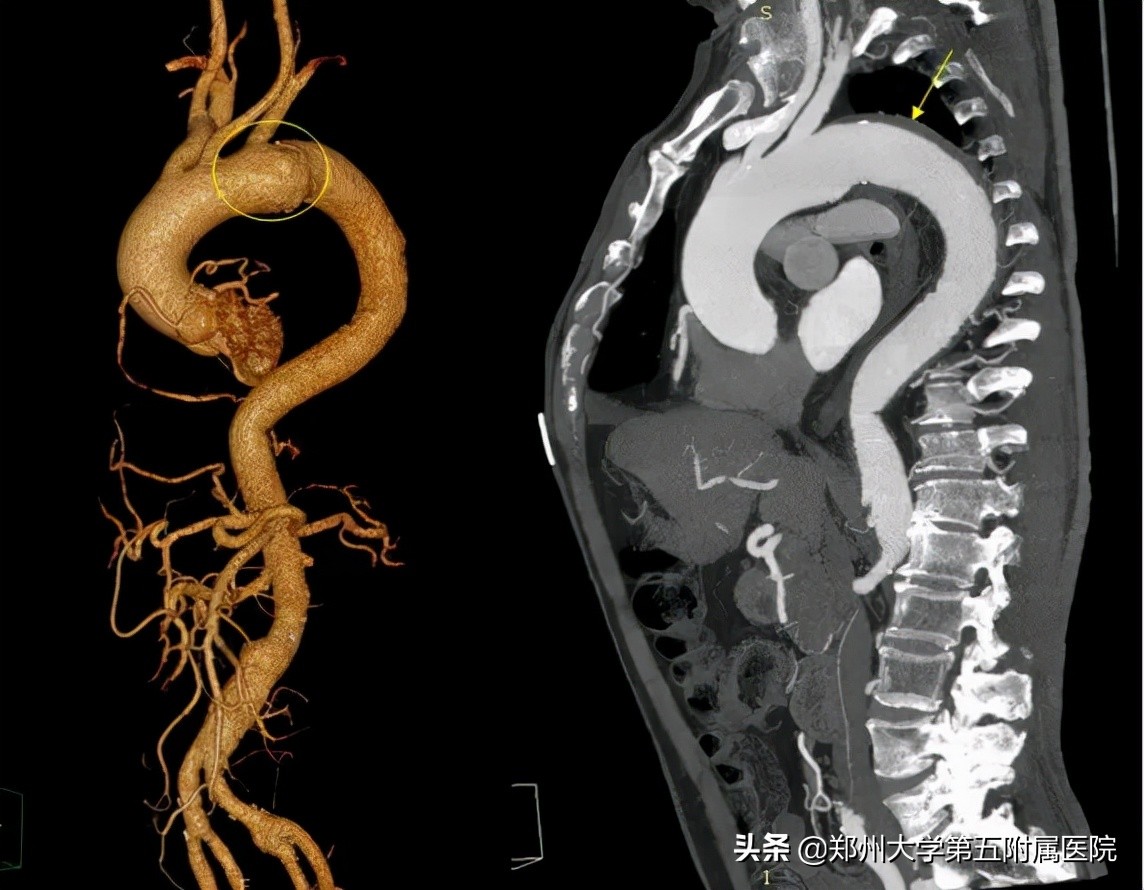 主动脉夹层血肿不消是怎么回事,主动脉壁间血肿血压不稳定