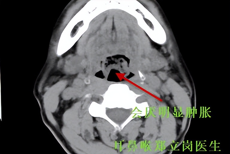 咽喉异物感吞咽困难胃镜检查正常,咽喉不适感越来越强烈怎么治