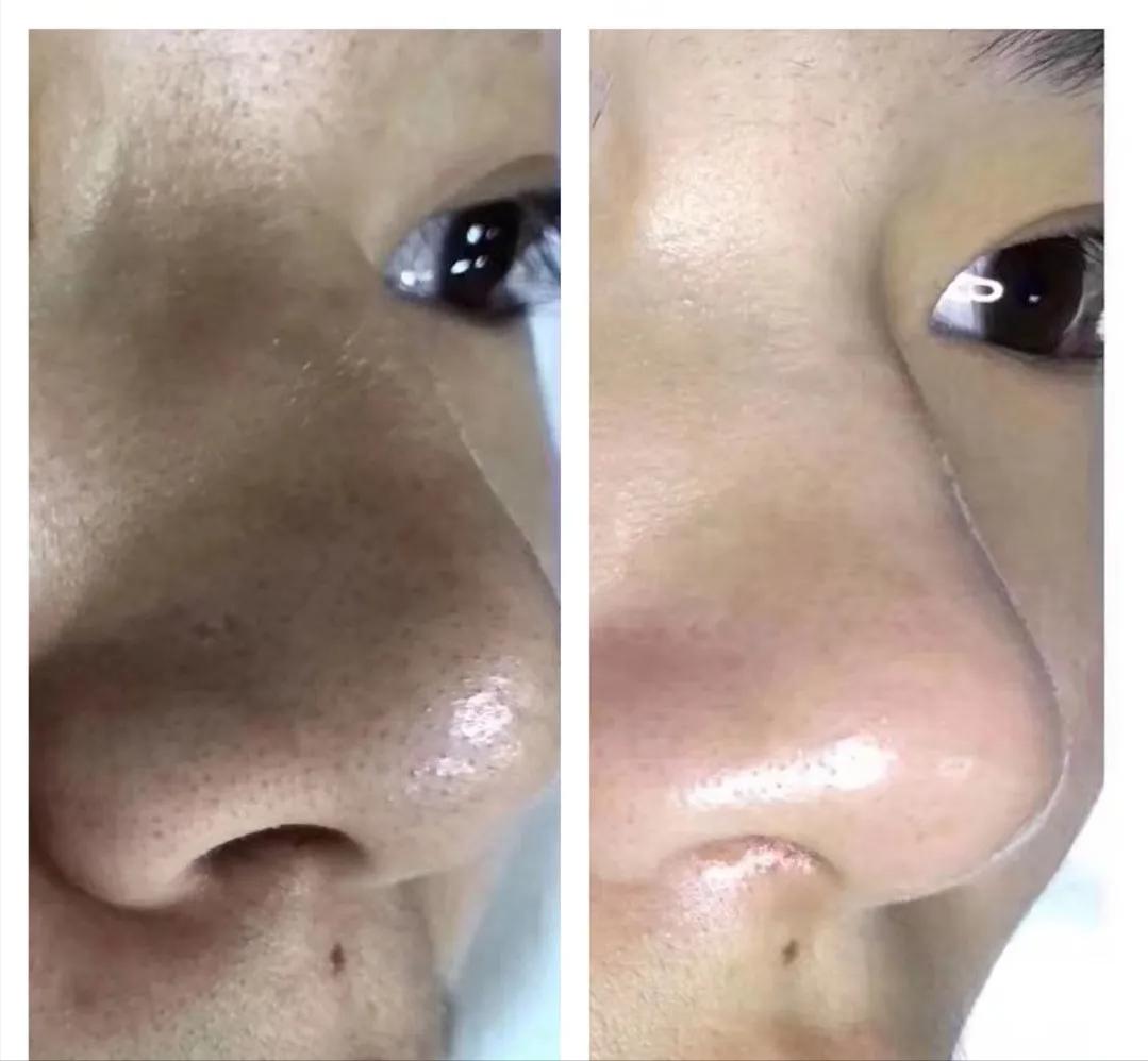 去鼻子上的黑头最好的方法,去鼻子上黑头的有效方法