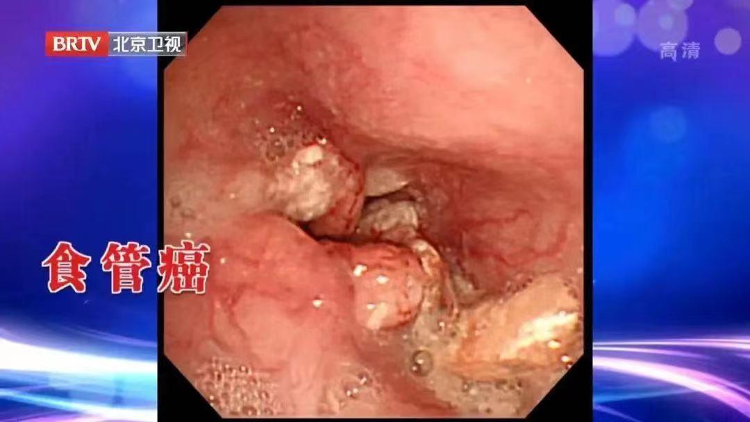 癌细胞正确吃法,癌细胞最怕的一种食物一定要常吃