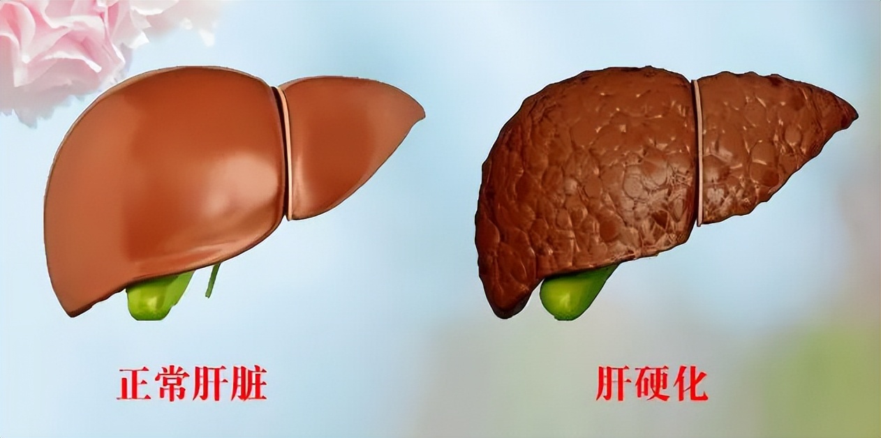 大量腹水如何治疗,腹水的中医特殊疗法