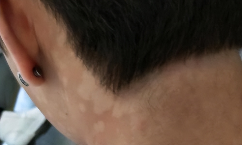 一到夏季，后背长了一些褐色的斑点，这是什么皮肤病？