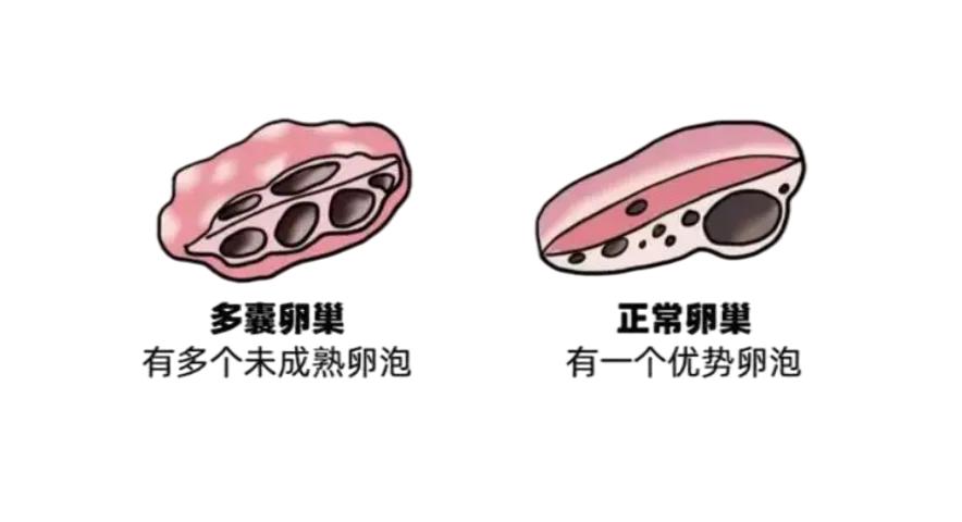 b超多囊但是有优势卵泡,b超多囊是还没排卵吗