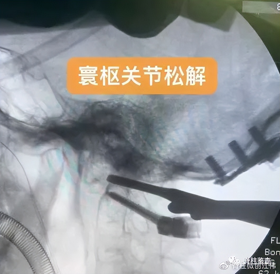 颅底凹陷症齿状突半脱位,颅底手术新突破