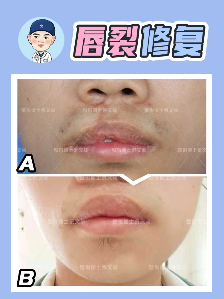 唇裂科普,唇裂修复案例