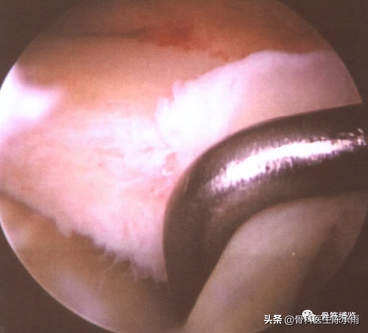 膝关节2度损伤需要做关节镜吗,膝关节常见损伤的检查方法