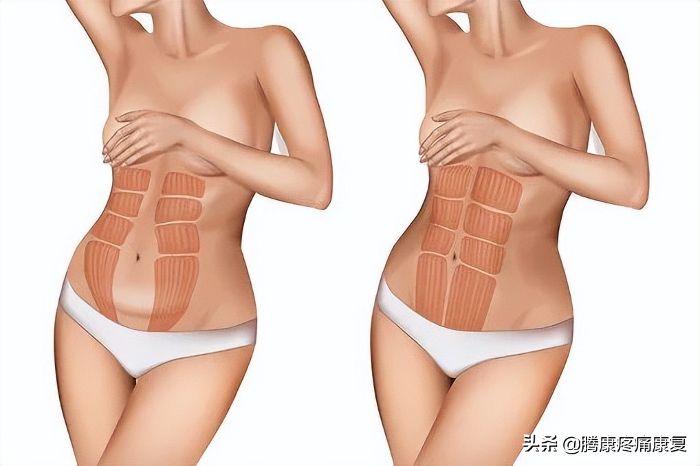 产后腹直肌分离康复训练方法,腹直肌分离的康复动作