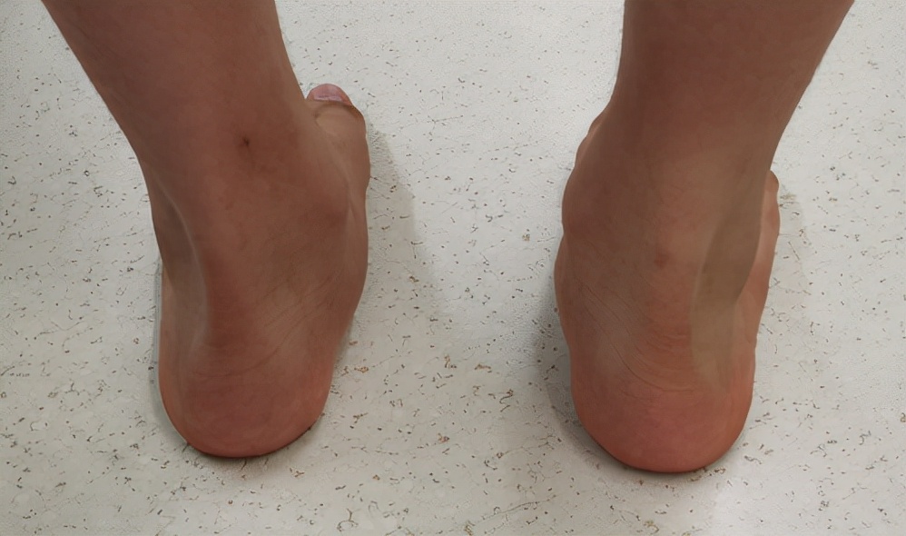 距下关节制动术成人效果如何,距下关节制动器作用