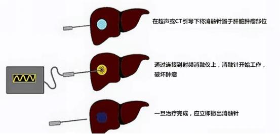 120万一针杀死癌细胞的方法,一针冻死癌细胞多少钱
