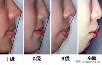 最让人显老的法令纹应该如何解决,法令纹和嘴角纹哪个更显老