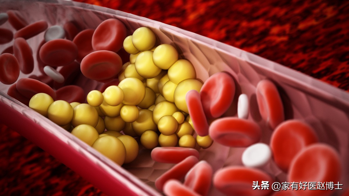 iwatch怎么预防心梗脑梗,张之瀛大夫如何预防心梗和脑梗