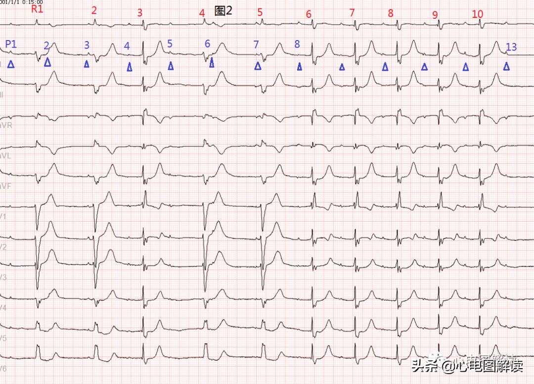 二度房室阻滞、室性早搏、室性逸搏？