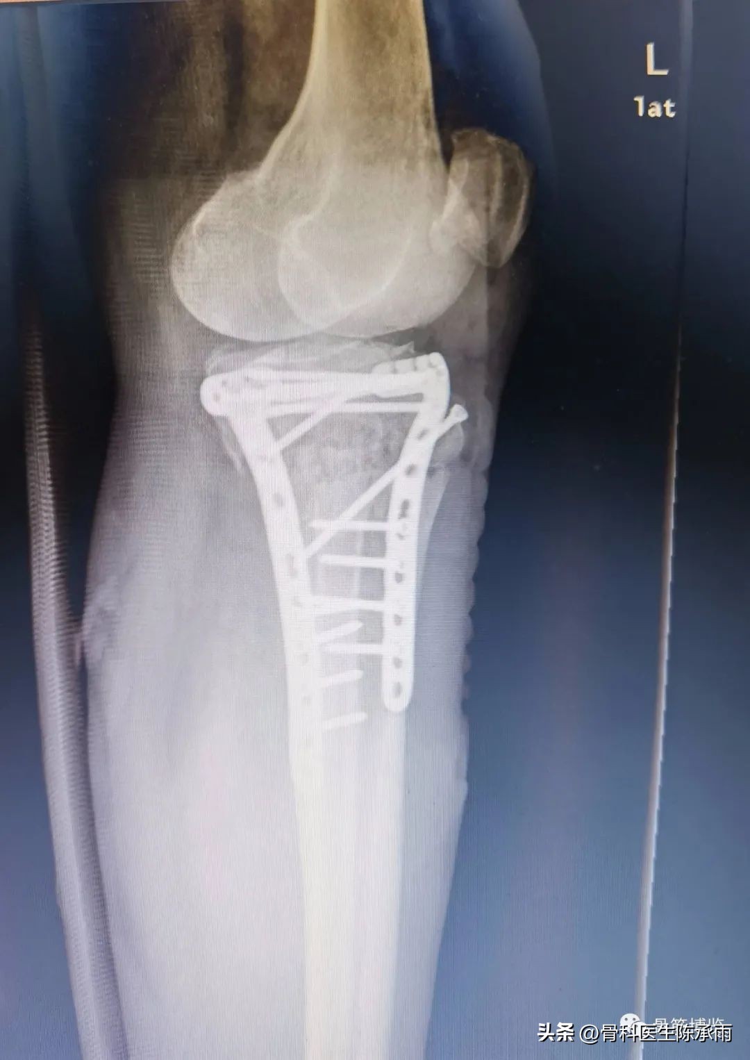 膝关节胫骨平台骨折,最近胫骨平台骨折视频