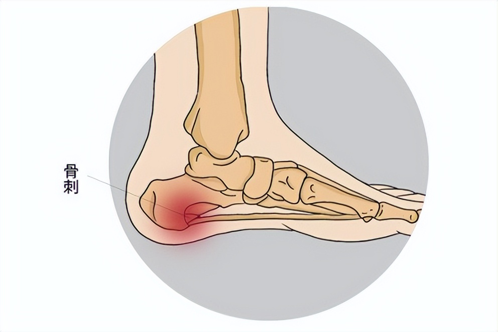 下地走路脚后跟痛走一会儿后缓解,跑完步脚后跟疼痛如何缓解