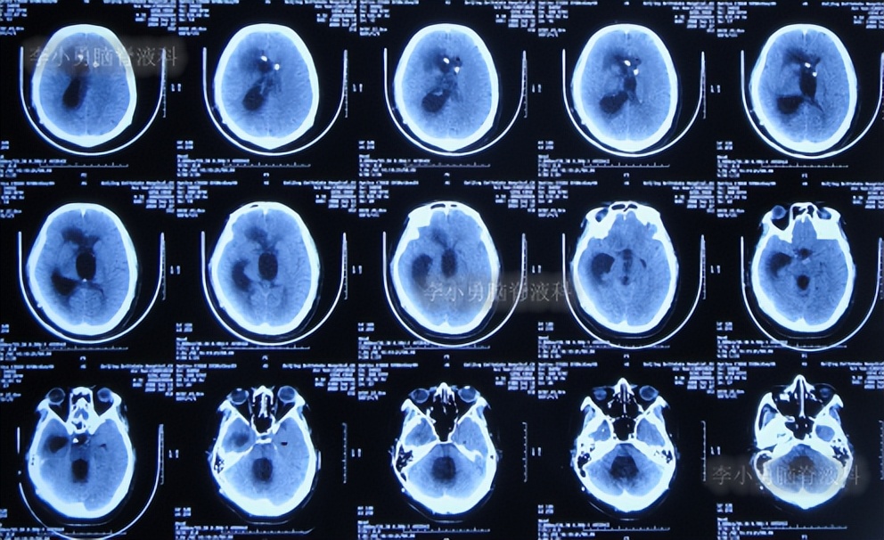 脑积水三脑室造瘘多久能恢复,脑囊虫手术后脑积水