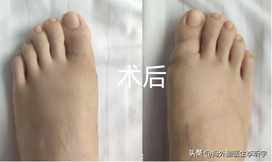 遗传性拇外翻能矫正过来吗,遗传性脚趾拇外翻怎么避免