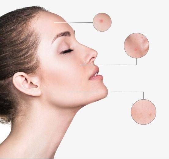 脸上长痘痘需要注意什么,脸上长痘痘应注意事项
