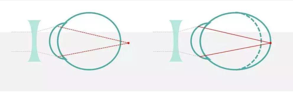 角膜塑形镜控制度数的原理是什么,角膜塑形镜控制近视度数增长