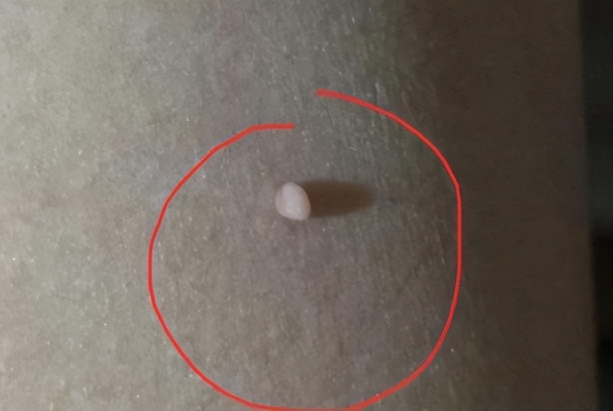 脖子和腋下的小肉粒可以揪掉吗,腋下的小肉粒能揪掉吗