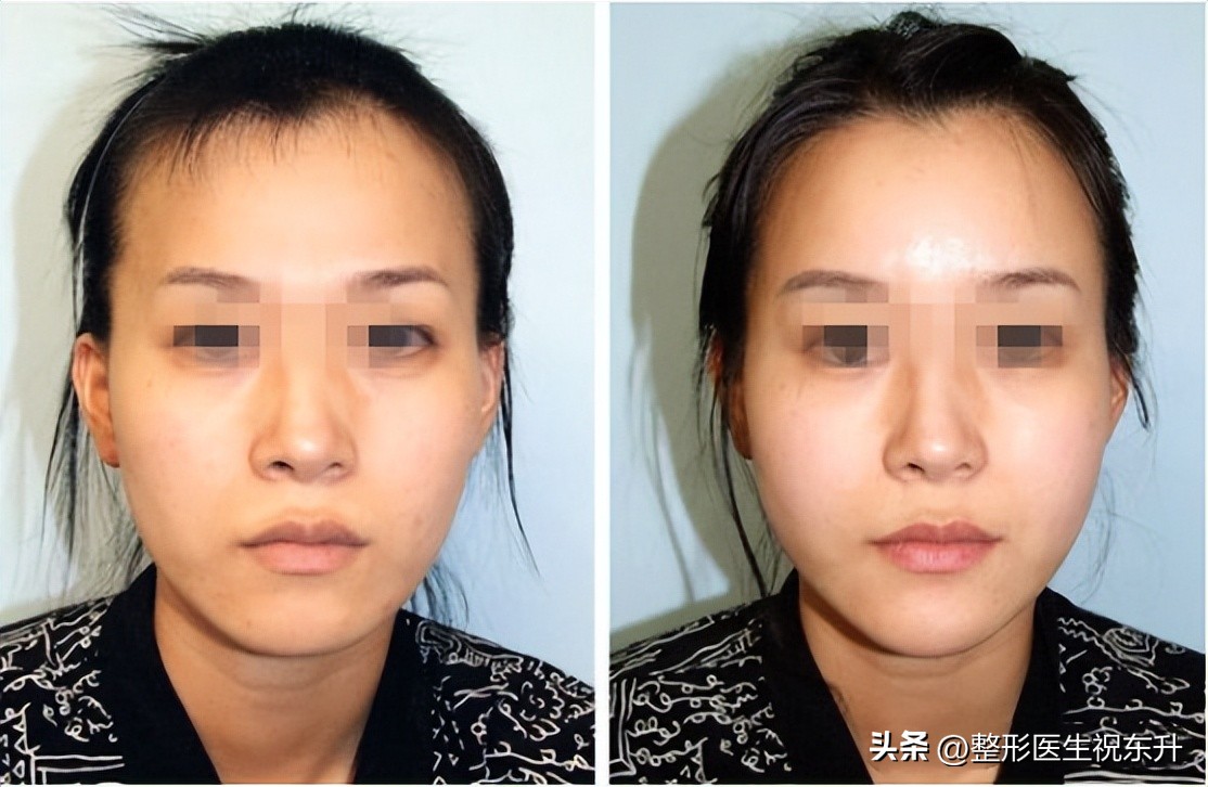 面部年轻化项目,面部年轻化案例