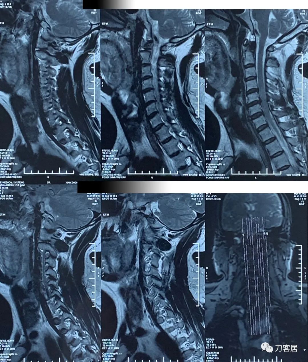 左上肢麻木的病历,颈椎病颈肩胳膊发麻用手术么