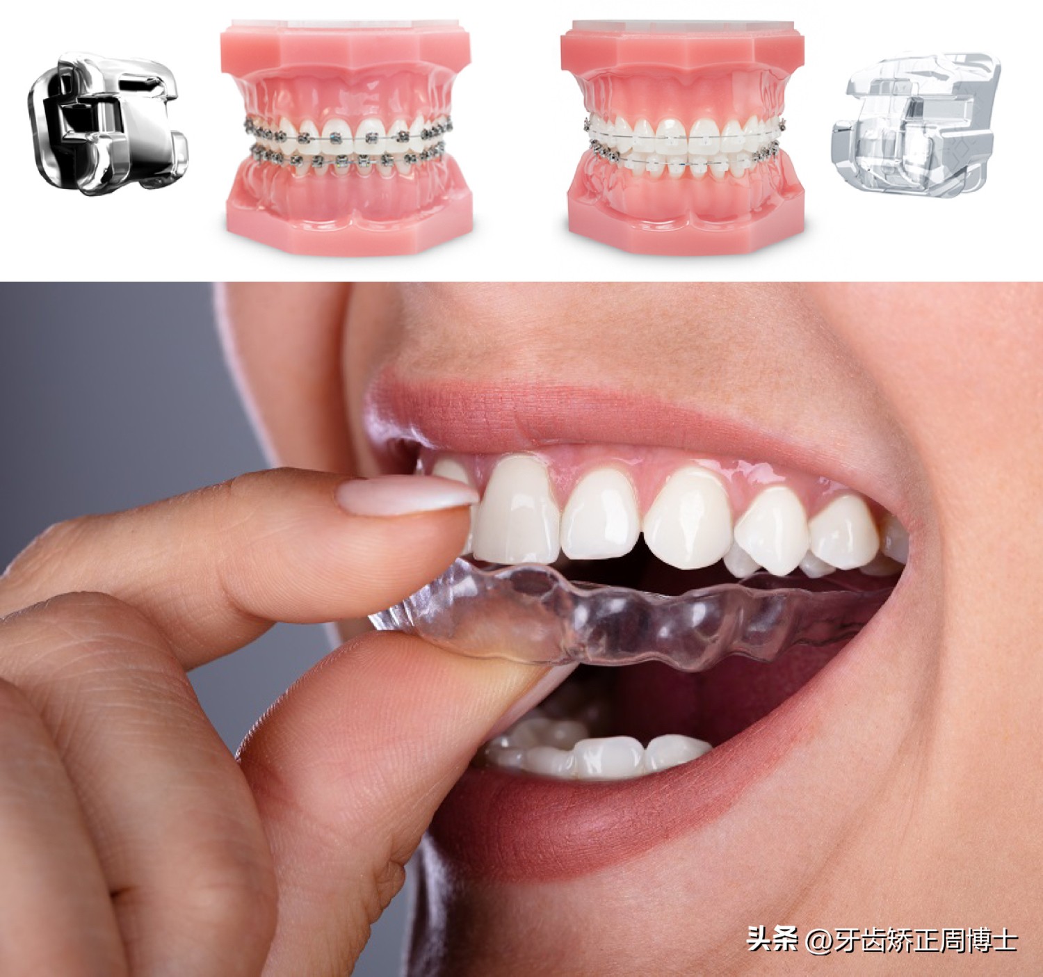 隐形矫正龅牙效果图,严重龅牙可以用隐形矫正吗