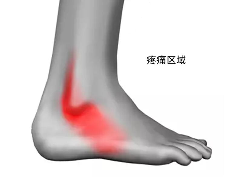 崴脚后，脚踝外侧一直疼痛，什么是腓骨肌腱损伤，严重吗？