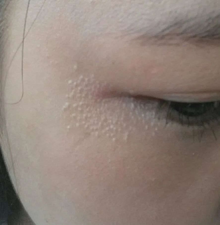 眼睛周围总感觉有飞虫是怎么回事,眼睛周围有飞虫的感觉