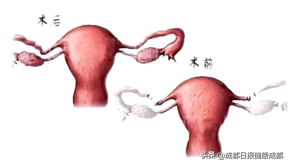 输卵管复通手术亲身经历,健康医学科普希望能帮到你