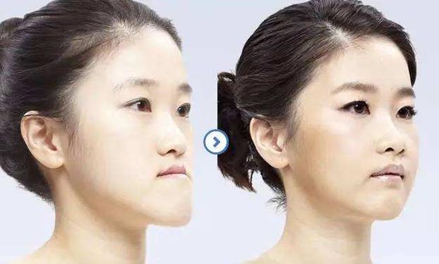 牙齿地包天导致骨头严重畸形,牙齿畸形缺失地包天怎么办