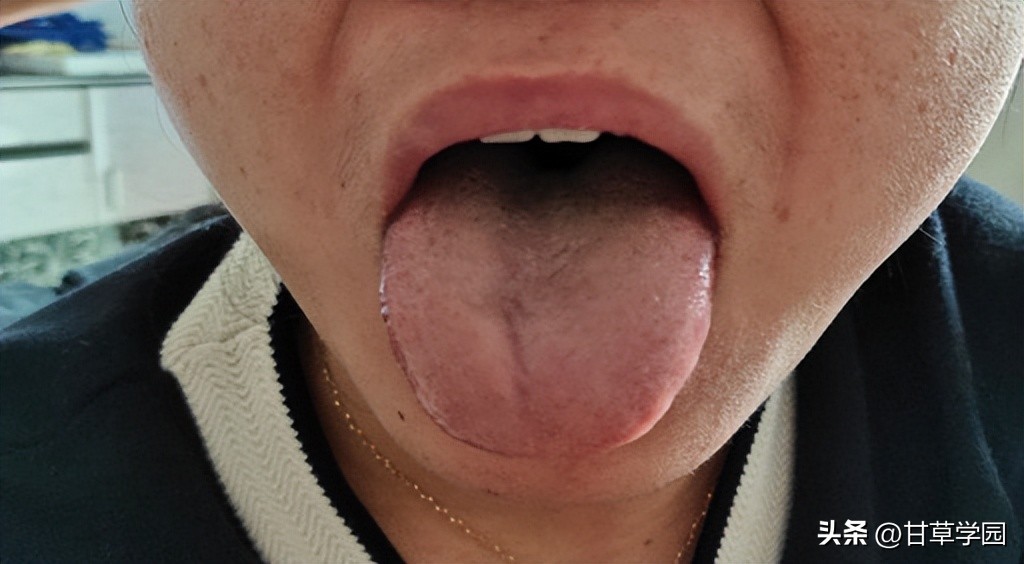 薯蓣丸治疗荨麻疹,柴胡桂枝干姜汤治疗荨麻疹