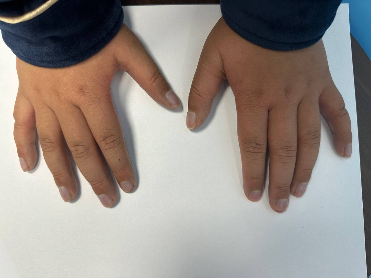 儿童遗传性毛细血管扩张会自愈么,遗传性出血性毛细血管扩张ct表现