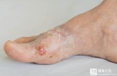 皮肤病与糖有关吗,抗糖一个月的皮肤变化