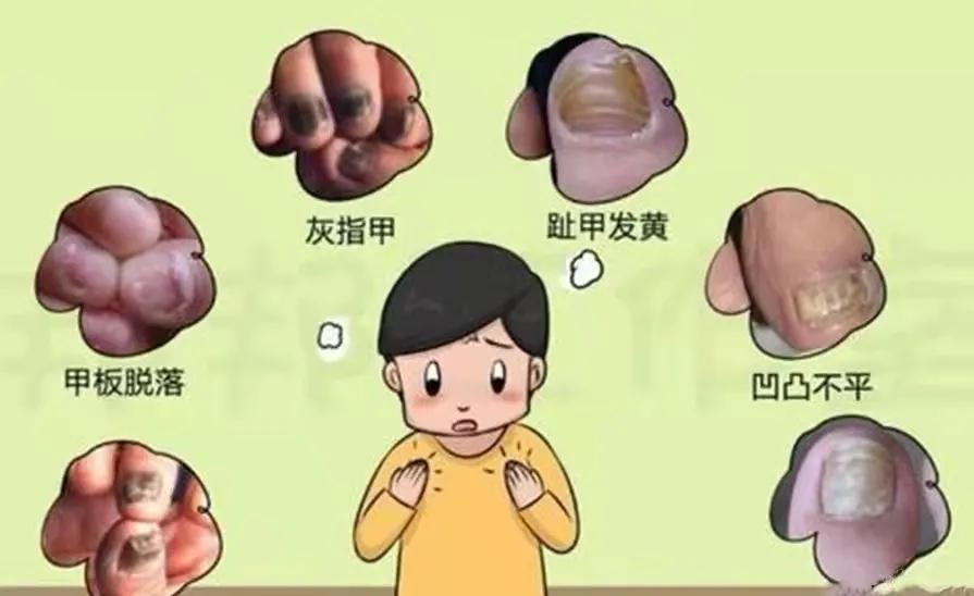 灰指甲长什么样子用什么药,灰指甲什么样