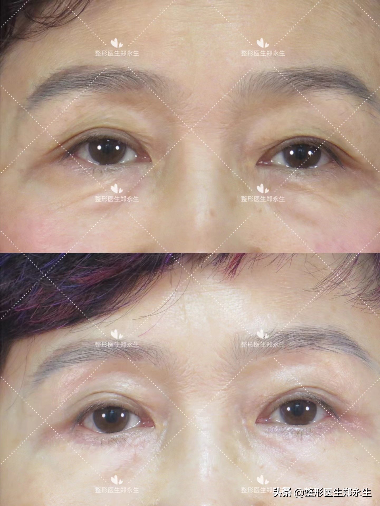 眼袋大最好的去眼袋的方法,眼袋大的原因和去眼袋方法