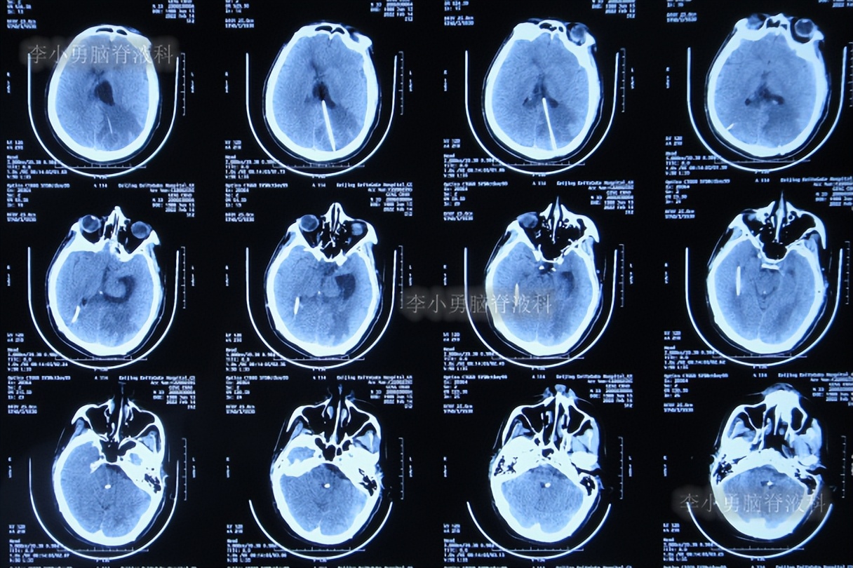 脑积水三脑室造瘘多久能恢复,脑囊虫手术后脑积水