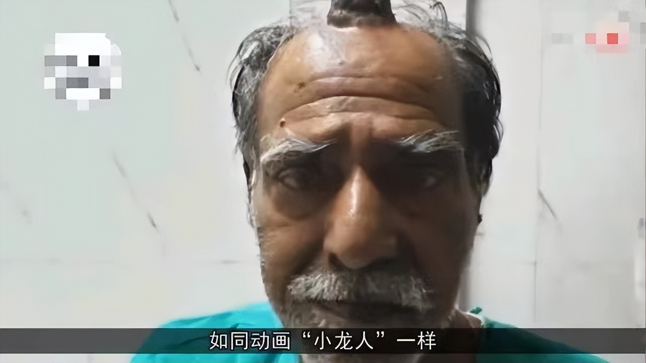 112岁老人头上长犄角,107岁老人头上有个长犄角