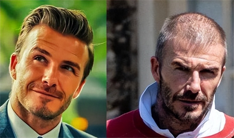 连明星都逃脱不了的高发际线时尚,雄秃现状