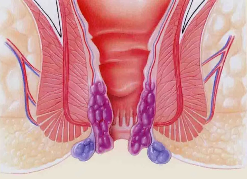 大便带血对身体有什么危害,大便带血什么问题