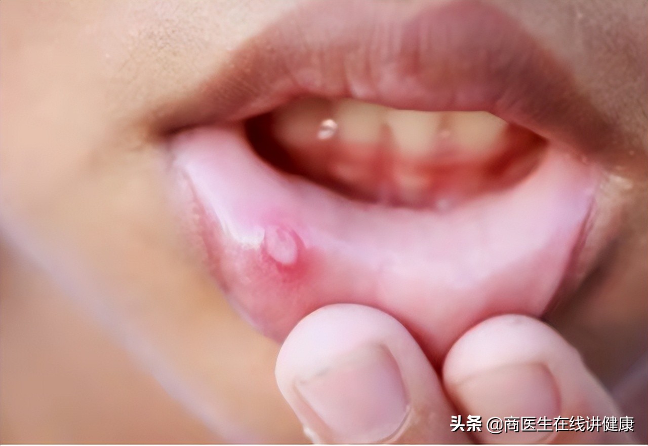 口腔溃疡含维c特别疼,有一种痛叫口腔溃疡